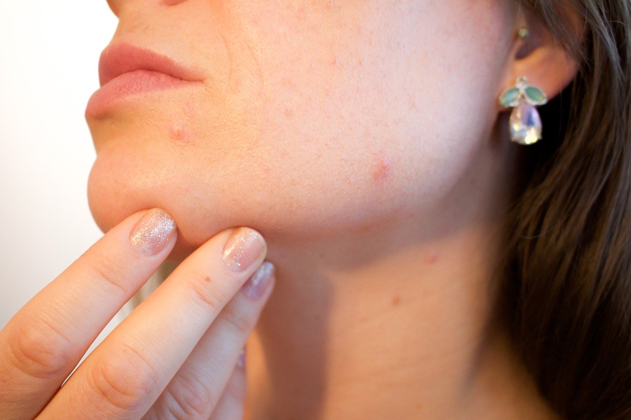 Skin Imperfections